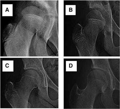 Effect of hip dysplasia on the development of the femoral head growth plate